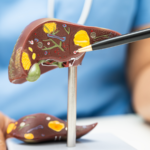 Fatty Liver in Young Indians: Causes, Cure & Diet